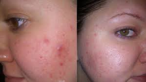 Ridurile sunt unii dintre cei mai mari dusmani ai femeilor, iar lupta contra lor pare sa nu se termine niciodata. Crema Minune Care Te Scapa De Cosuri Si Poate Fi Facuta In Casa Buna Ziua Iasi Bzi Ro