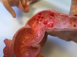 Image result for blood in stool human poop