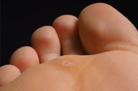 Tapi kalau gatal itu terjadi di telapak kaki, mungkin kamu akan berpikir ulang. 4 Penyakit Kulit Yang Biasa Muncul Di Kaki