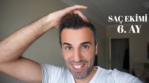 Sac Ekimi 6 Ay Hair Transplantation Youtube
