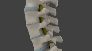 Degenerative Disc Disease Stem Cell Treatment Tijuana Cancun