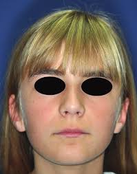 Modifications péri-orales fonctionnelles et morphologiques lors du  traitement précoce des malocclusions de classe II division