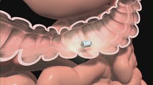 Image result for Wireless Capsule Endoscopy