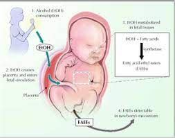 Behavioral Disorders Fetal Alcohol Syndrome Birth Defects Group 13