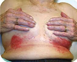 Image result for Intertrigo under breasts