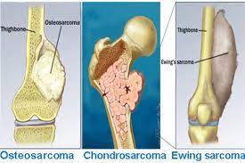 How does the doctor know i have bone cancer? Bone Cancer Archives Oncoplus Hospital