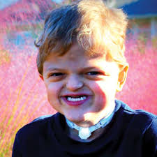 thankful for crouzon syndrome