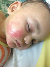 Makanan yang kebiasaannya menyebabkan tercetusnya eczema adalah susu lembu, telur, soya, gandum, kekacang dan makanan laut. Shazwani Hamid S Blog November 2016