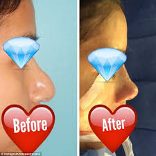 How much is a bbl with dr miami. Dr Miami Michael Salzhauer Shares Graphic Before And After Plastic Surgery Photos Daily Mail Online