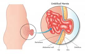 perbaikan hernia umbilikalis gejala penyebab dan