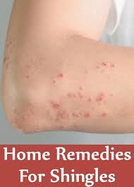 11 Home Remedies For Shingles Natural Headache Remedies Natural Sleep Remedies Migraines Remedies