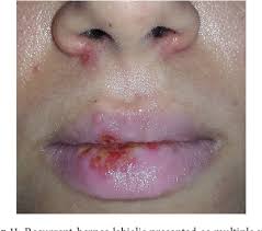 PDF] Diagnostic Features of Common Oral Ulcerative Lesions: An Updated  Decision Tree