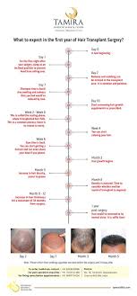Hair Transplant Timeline Inforgraphic From Day 0 To Day 365