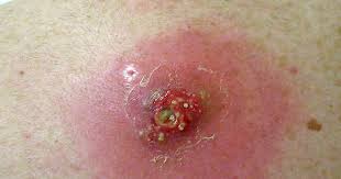 Aureus can sometimes get into the bloodstream and travel to internal parts of the body to cause more serious infections. Deadly Skin Infection 12 Graphic Photos That Could Save Your Life Cbs News