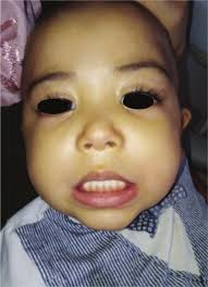 Dentist's challenge in diagnosis and treatment of Langerhans cell  histiocytosis in a 3-year-old child: Case report