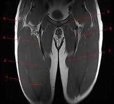 We look at the associated symptoms and treatment options. Mri Of The Thigh Detailed Anatomy Superior Part W Radiology