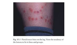 Image result for Papular urticaria
