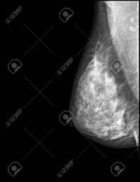 This type of cancer also changes the appearance of your breasts. X Ray Breast Cancer Mamary Tumor Stock Photo Picture And Royalty Free Image Image 53465851