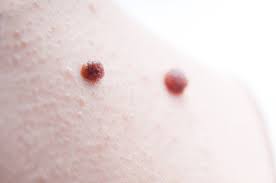 But if the area is damaged—say, because of a developing skin … Procedures For Mole Removal Harley Street Dermatology Clinic