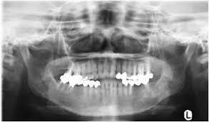 Imprint cytology of osteosarcoma of jaw. Conventional Osteosarcoma Of The Mandible Successfully Treated With Radical Surgery And Adjuvant Chemotherapy After Responding Poorly To Neoadjuvant Chemotherapy A Case Report Journal Of Medical Case Reports Full Text