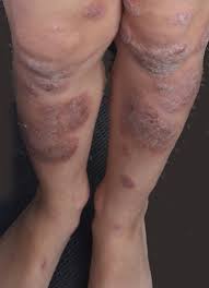 We did not find results for: Severe Nummular Eczema In Childhood Experience Of Six Cases Managed With Oral Methotrexate European Journal Of Pediatric Dermatology
