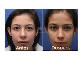 La bichectomia o cirugía de los cachetes es el procedimiento mediante el cual se retira las bolsas de grasa de la parte inferior de los cachetes también conocidas como bolsas grasas de bichat. Cirugia Cachetes Antes Y Despues De Adelgazar Operacion De Pomulos Antiguamente Y Despues De Afinarse