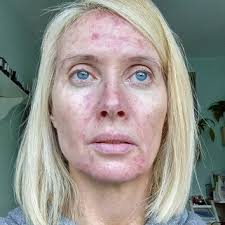 Particularly in advanced skin cancer, relieving symptoms will be an important part of cancer care and treatment. Skin Cancer Symptoms News Tips Guides Glamour