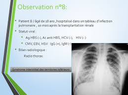 Infection pulmonaire qui se soigne bien, la pneumonie peut toutefois se révéler plus grave en cas de complications comme l'explique le dr gérald kierzek dans questions de santé. Infections Pulmonaires Opportunistes Apres Transplantation Renale Ppt Telecharger