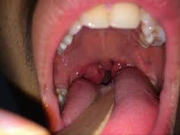 Image result for Peritonsillar Abscess