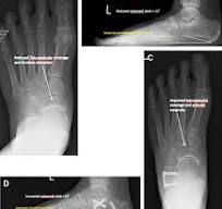 Lateral column lengthening osteotomies. | Semantic Scholar