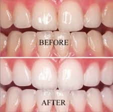 Peroxide is effective, but it can irritate the nerve endings of your teeth and cause sensitivity. Teeth Whitening Certification Live Instructor Online Training Program Launched