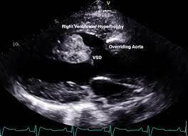 Tetralogy of Fallot