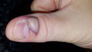 People who are septic are in a state. Grandfather Left Fighting For His Life After Developing Sepsis From Biting His Finger Nails Social Junkie