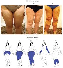 Lipedema Friend And Foe Hormone Molecular Biology And