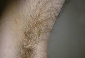 Your question is not clear. Racgp Doctor My Armpit Hair Has Turned Yellow