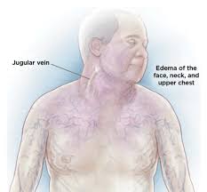 They form by the fusion and elongation of numerous precursor cells called myoblasts. Diagnostic Snapshot Acute Edema In The Oncology Patient Abstract Europe Pmc
