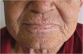 20 Year Follow Up Study Of Danish Hht Patients Survival And Causes Of Death Orphanet Journal Of Rare Diseases Full Text