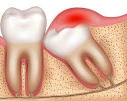 3 Reasons for Wisdom Tooth Removal