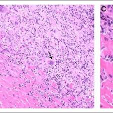 N myocarditis is an inflammatory disease of the heart muscle, diagnosed by established n the true incidence of myocarditis is unknown because the majority of cases are asymptomatic. Giant Cell Myocarditis Histology At Endomyocardial Biopsy Hematoxylin Download Scientific Diagram