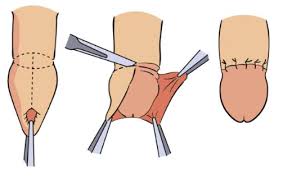 Image result for Phimosis