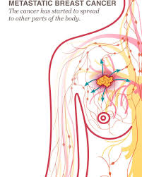 Pin By Ed Moore On Lymph Nodes And Other Detected Ca Cancer Breast Cancer Breast Cancer Awareness