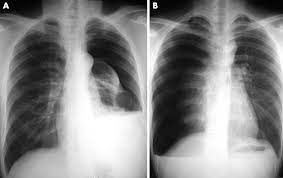 Maybe you would like to learn more about one of these? Indicators Of Haemothorax In Patients With Spontaneous Pneumothorax Emergency Medicine Journal
