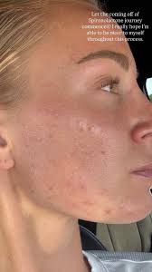 Coming Off Spironolactone