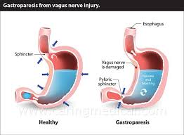 Cervical Spine Instability As A Cause Of Your Digestive Disorders Caring Medical In 2020 Gastroparesis Best Diets Gastroparesis Diet