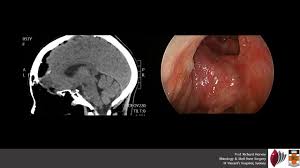 The area just inside the nostrils is other types of paranasal sinus and nasal cavity cancer include the following: Tumour Prof Richard Harvey