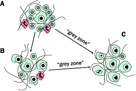 I was recently diagnosed with gray zone lymphoma. Lymphoma Evolution From Chl To Dlbcl Grey Zone Lymphoma May Be An Download Scientific Diagram