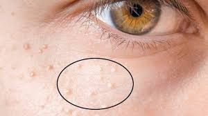 Namun, dalam sehari kamu tidak diperbolehkan terlalu sering mencuci wajah menggunakan sabun cuci muka karena akan mengganggu keseimbangan ph kulit yang bisa justru bisa berakibat fatal nantinya. Tips Kecantikan Hari Ini 5 Bahan Alami Untuk Menghilangkan Milia Di Wajah Madu Hingga Minyak Jarak Tribunnews Com Mobile