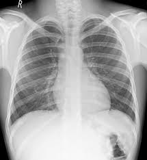 Pediatric Chest Pa Erect View Radiology Reference Article Radiopaedia Org