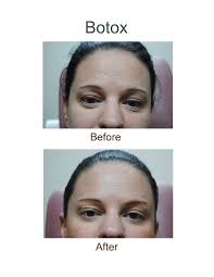 To actually answer your question, the heaviness feeling will last the length of the botox (although some say it can improve in the first month). Pin On Body Face Work