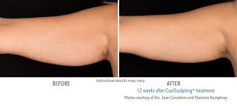 Maybe you would like to learn more about one of these? Coolsculpting Before And After Results From Actual Patients